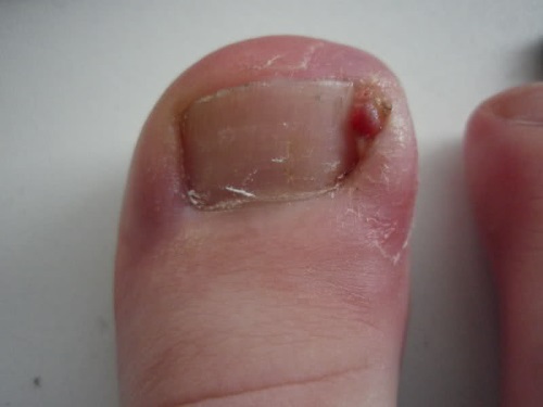 Ingegroede nagels genezen